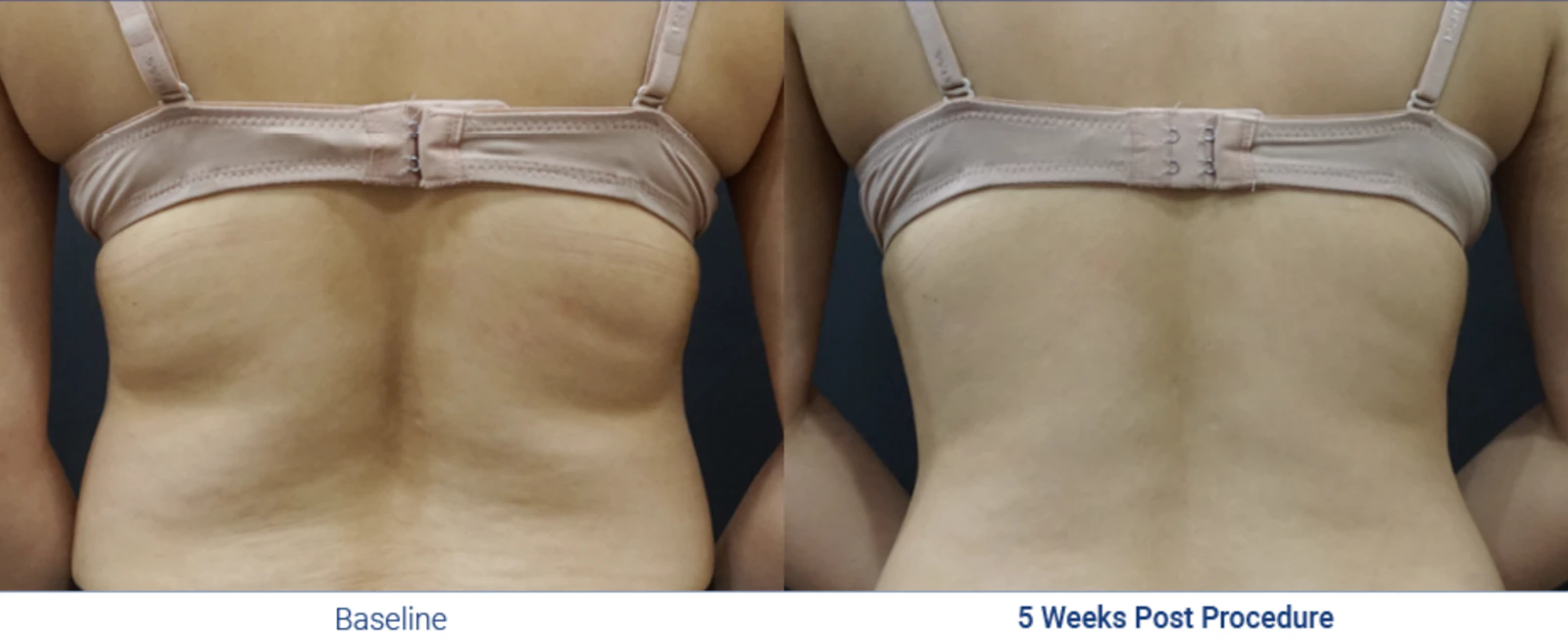 Fat freezing before and after, EF MEDISPA London