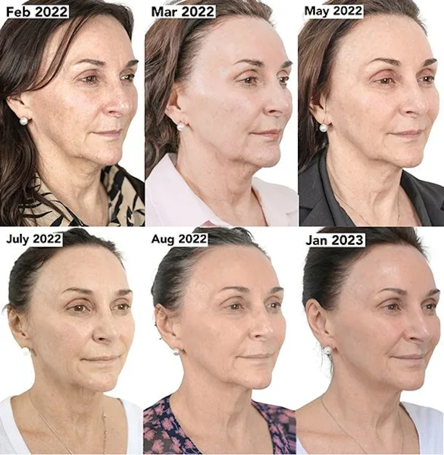NeoGen Plasma before and after result