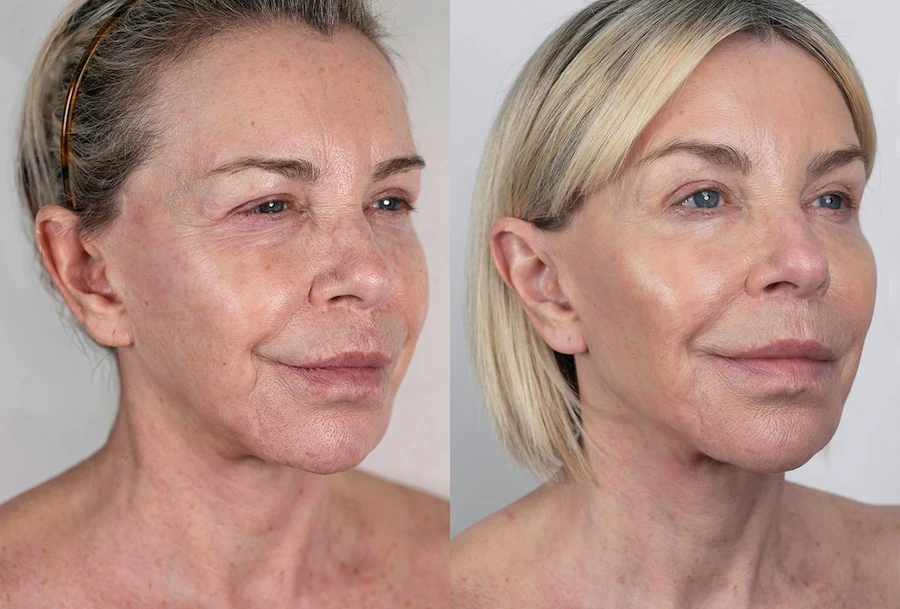 NeoGen Plasma before and after