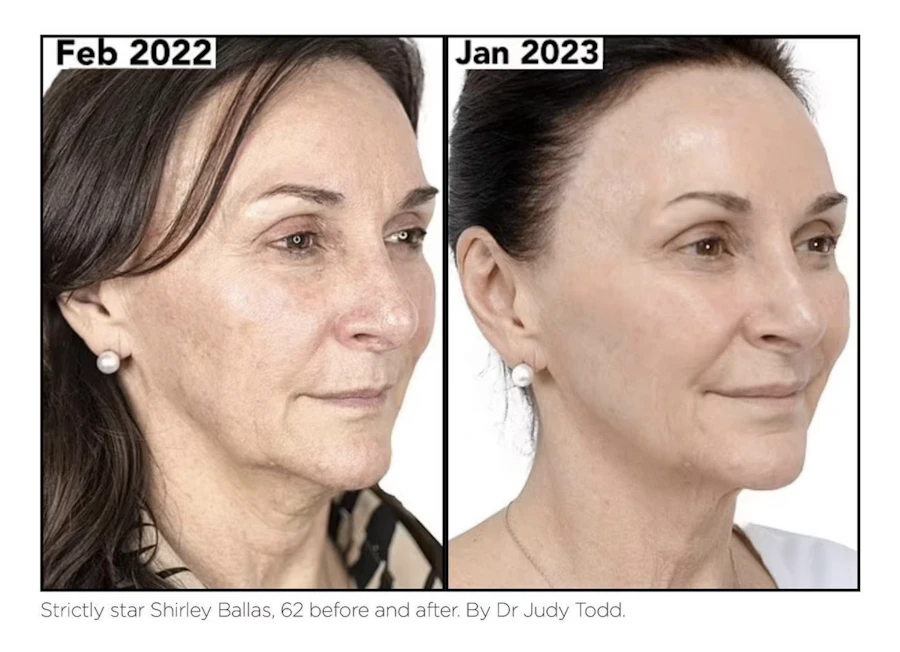 NeoGen Plasma before and after