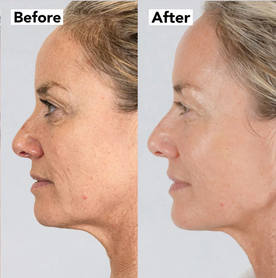 NeoGen Plasma before and after, side profile