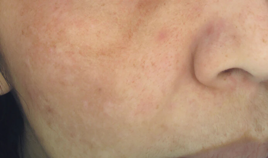 After Cosmelan Peel at EF MEDISPA