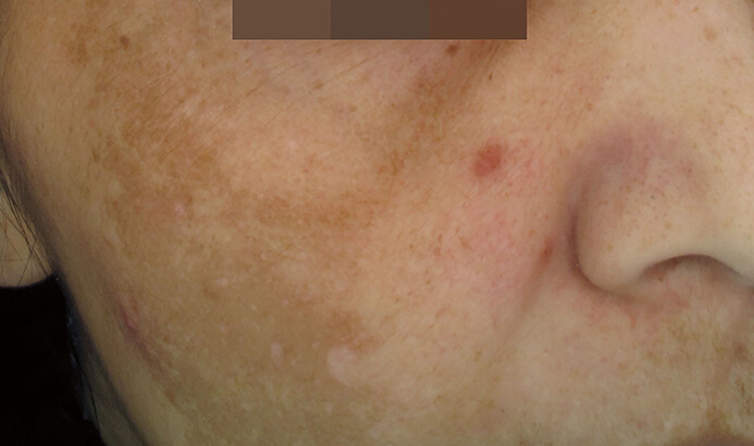 before cosmelan peel