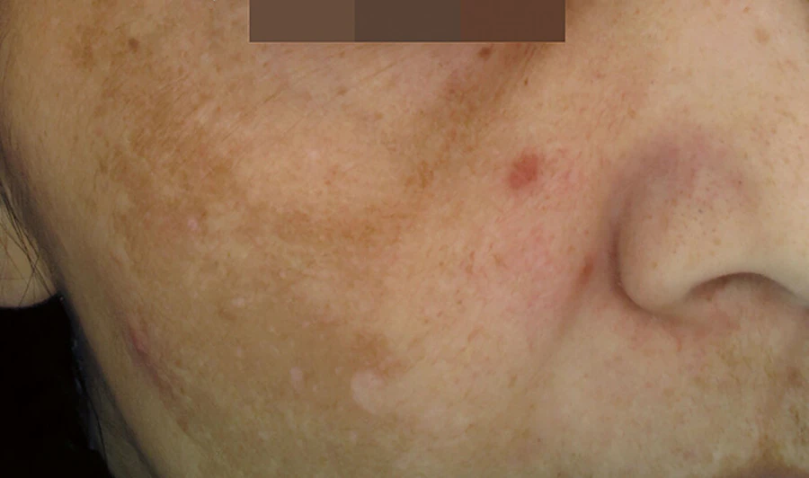 Before Cosmelan Peel at EF MEDISPA