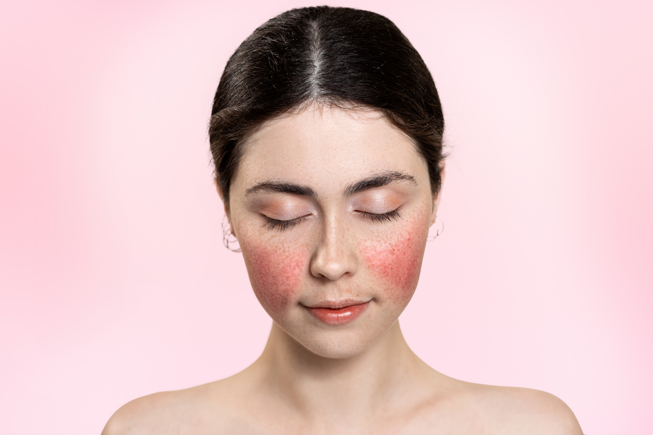 Unlocking the secrets of effective rosacea treatment: A guide to clear, radiant skin