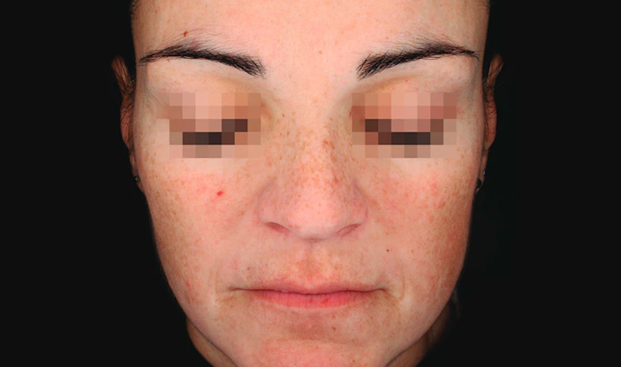 After Dermamelan Peel at EF MEDISPA