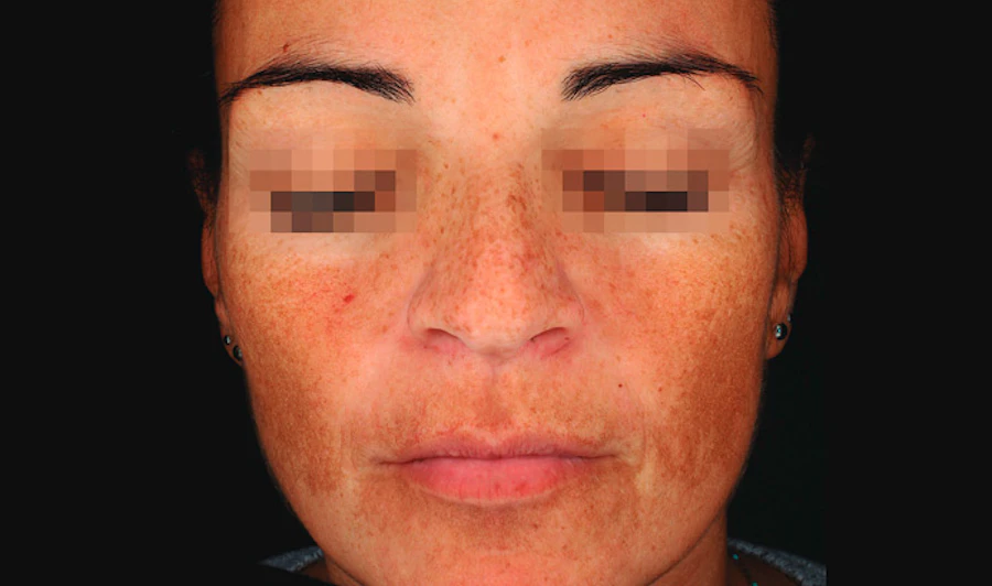 Before Dermamelan Peel at EF MEDISPA