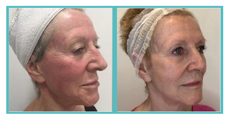 XO Supreme Face Treatment