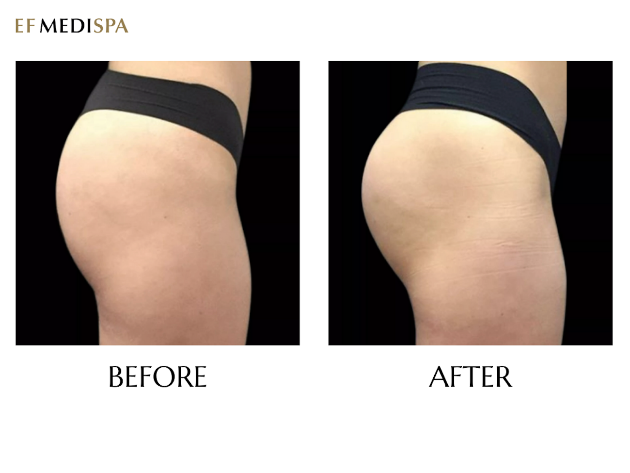 emsculpt Neo before and after