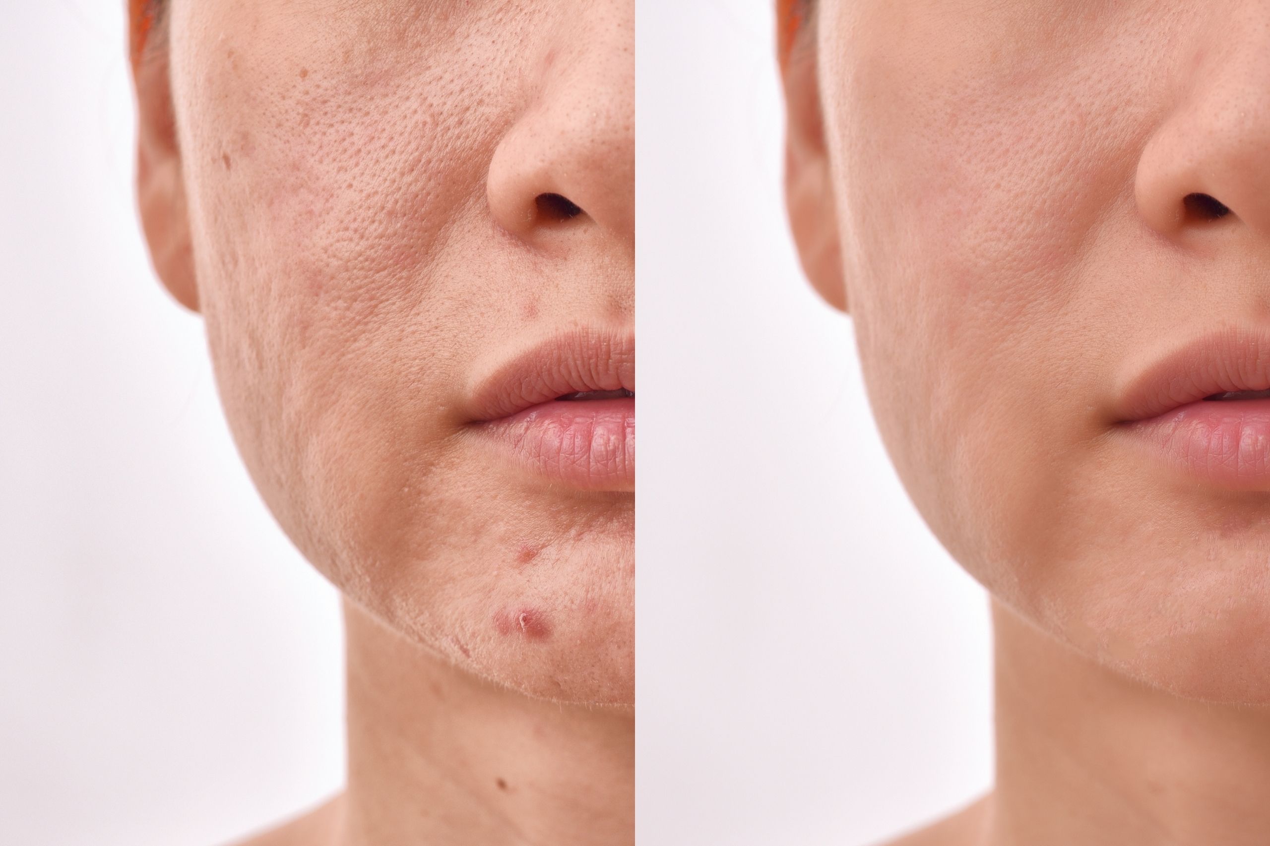 Mesotherapy Vs Microneedling: What Is The Difference?