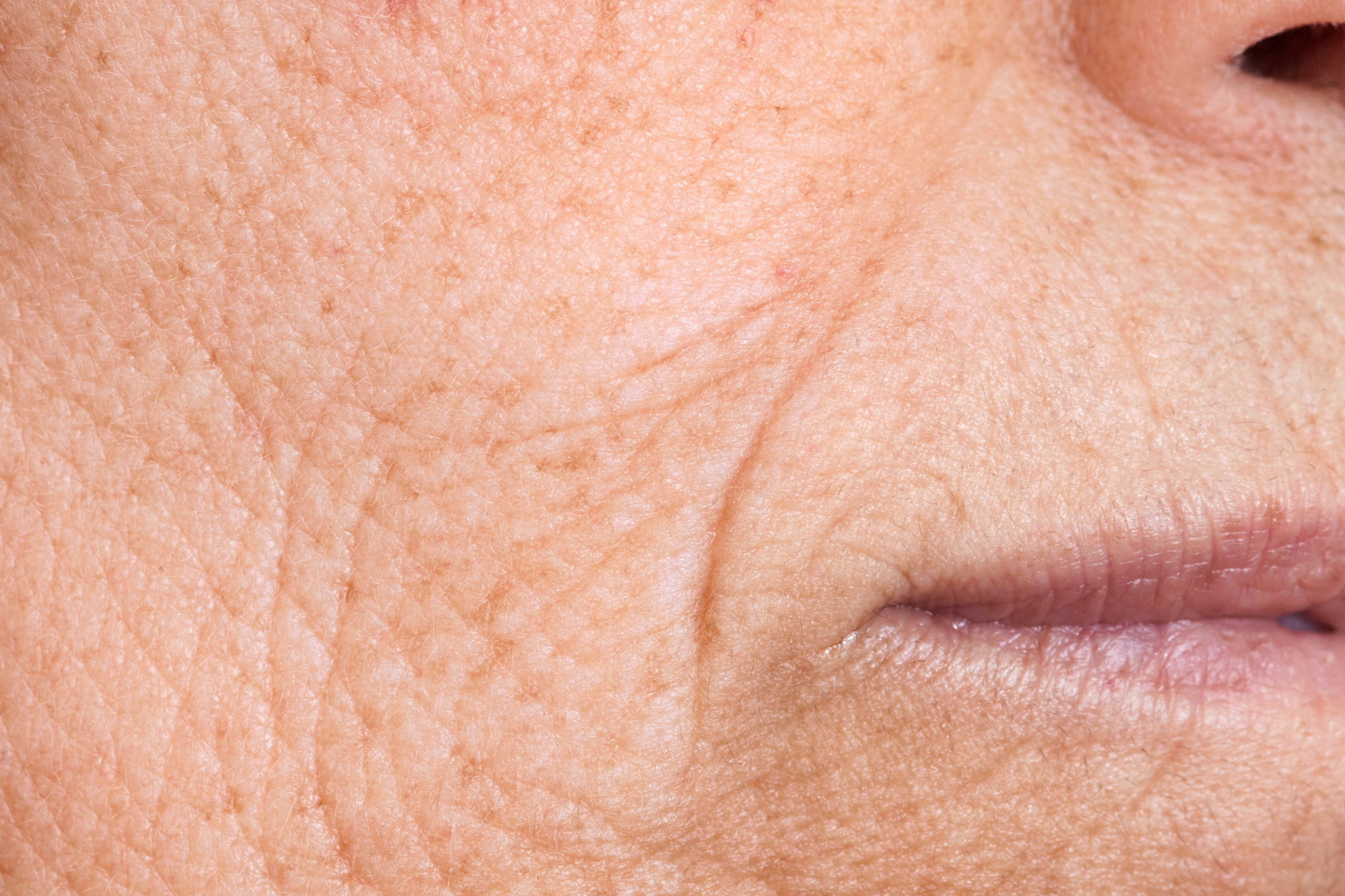 radio frequency for wrinkles