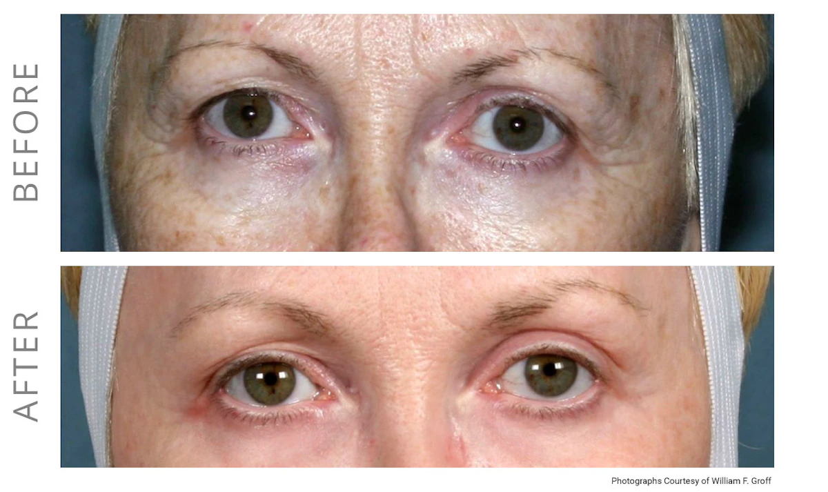 NeoGen Plasma before and after, eye area, EF MEDISPA London