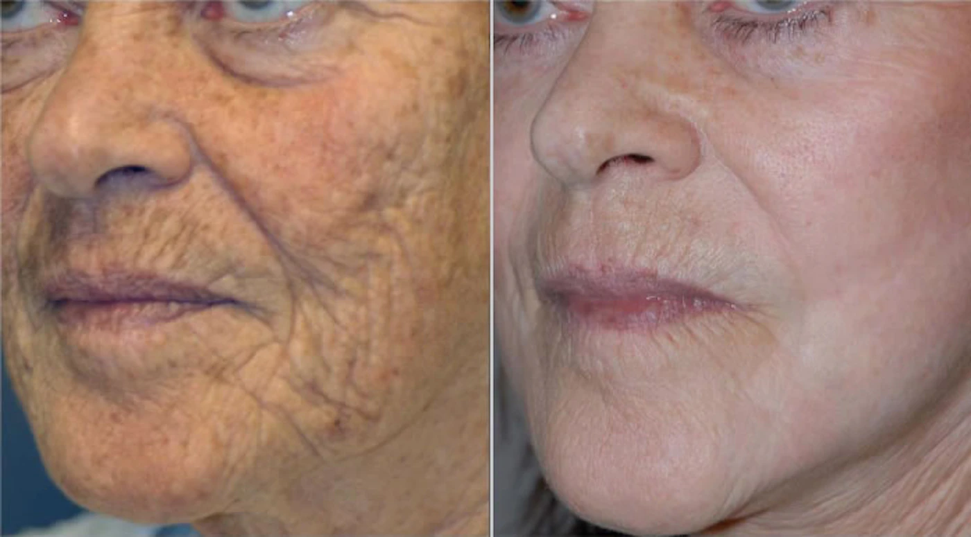 NeoGen Plasma before and after, full face, EF MEDISPA London