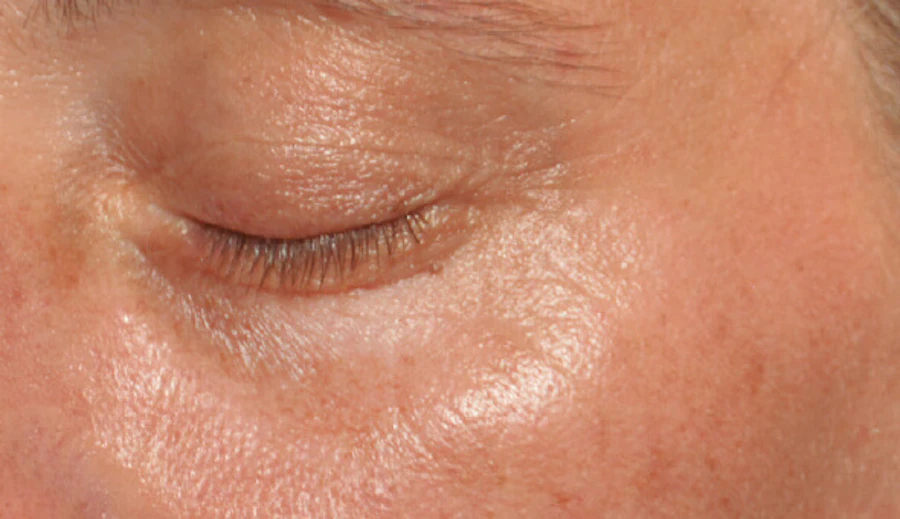 After Global Eyecon dark circle treatment