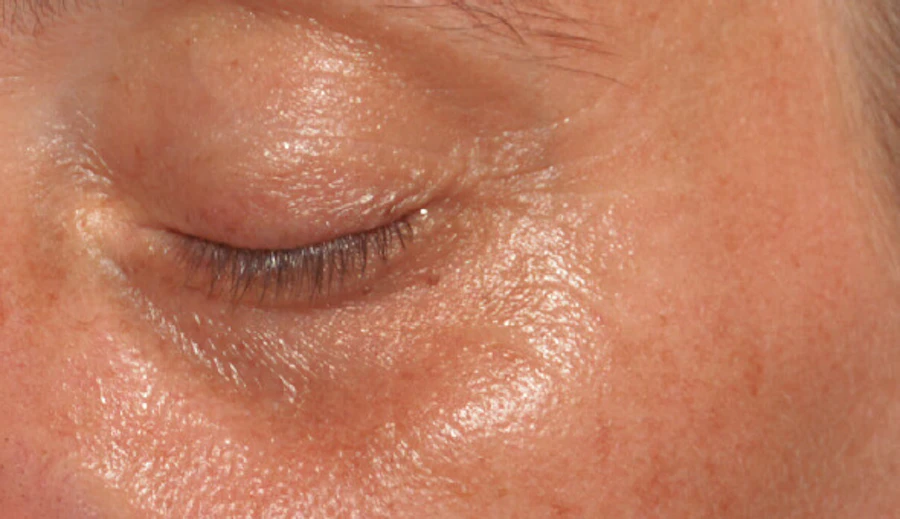 Before Global Eyecon dark circle treatment