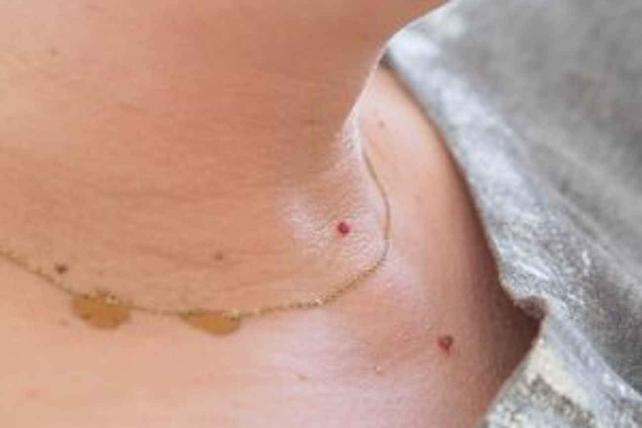 Should I Get a Skin Tag Removed? Here’s Our Advice