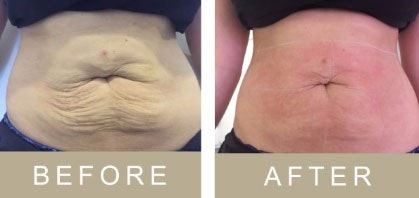3D SkinLift by Ultraformer Before & After