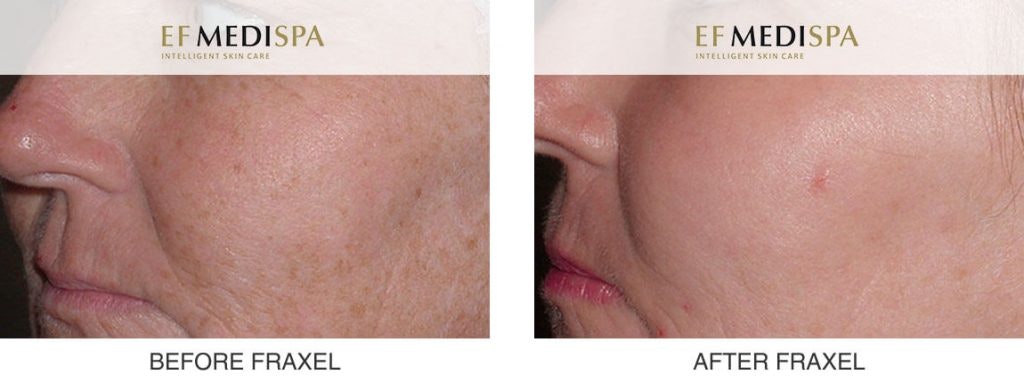 Fraxel Laser Treatment Before and After