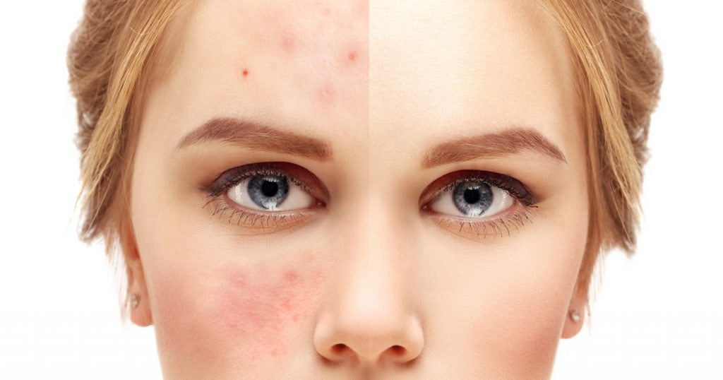 How CosMedix Can Help Acne & Adult Acne