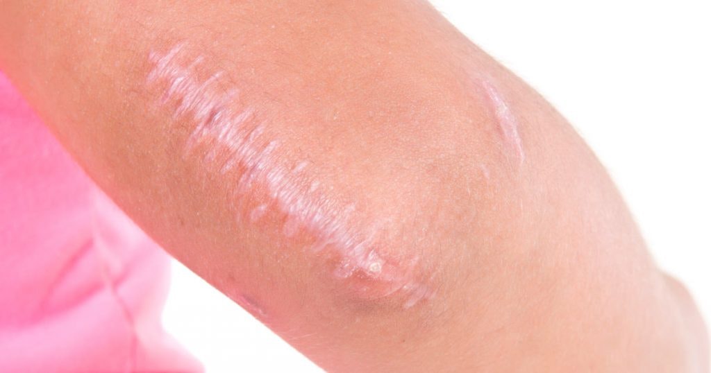 What Are Keloid Scars and How Can I Remove Them?