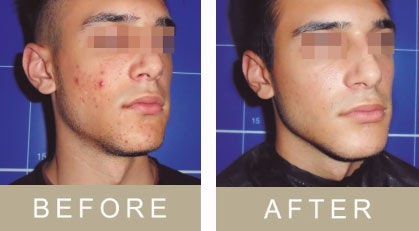 Acnelan skin peel before & after