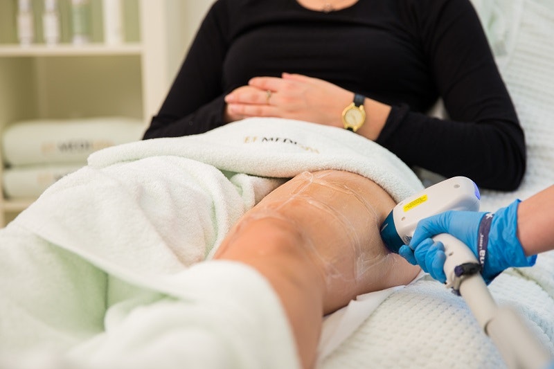 laser hair removal