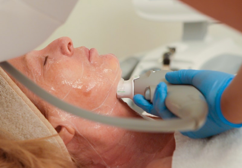 Radiofrequency and 3D Skin Lift by Ultraformer