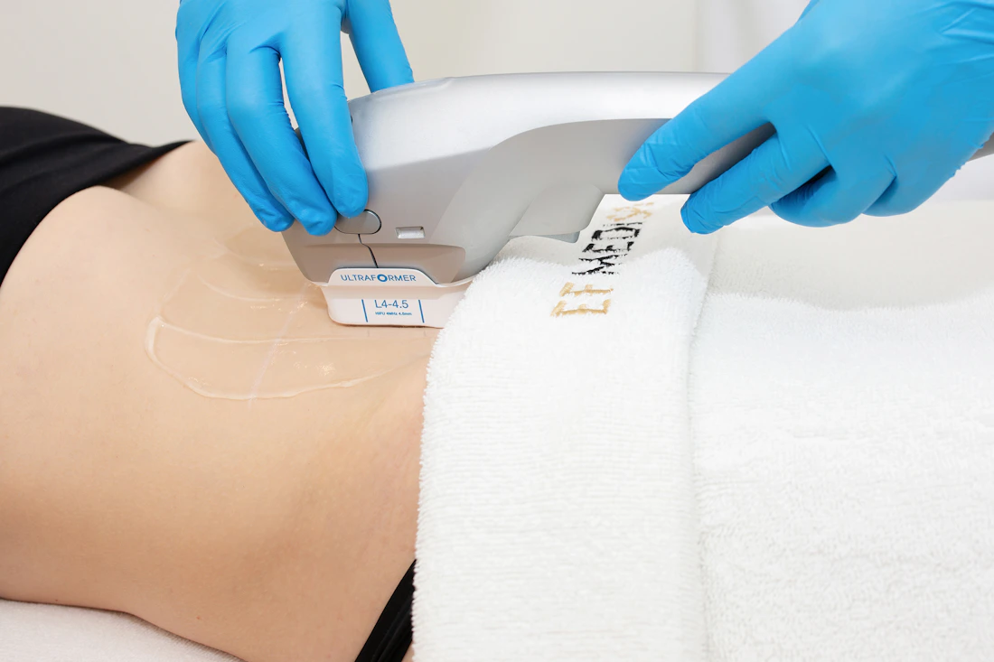 Ultraformer III HIFU treatment on the body at EF MEDISPA