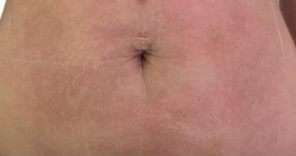 After Ultraformer III