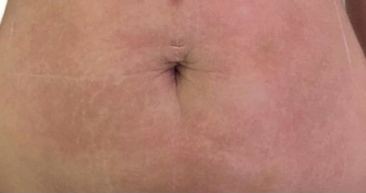 After 3D SkinLift by Ultraformer, EF MEDISPA London