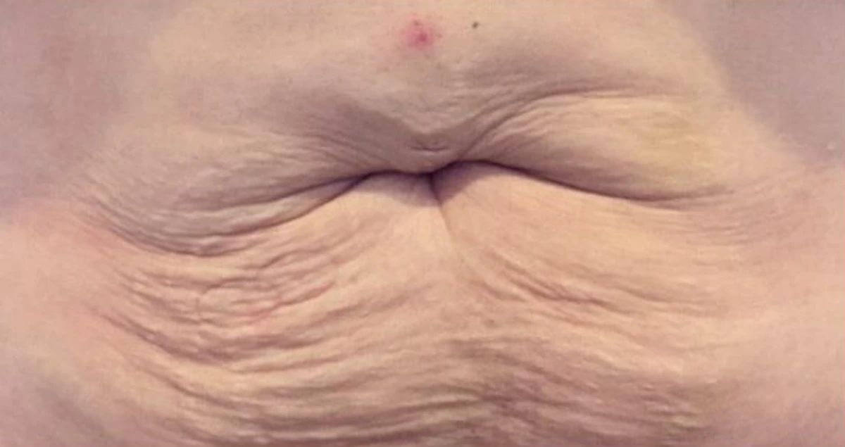 Before 3D SkinLift by Ultraformer, EF MEDISPA London