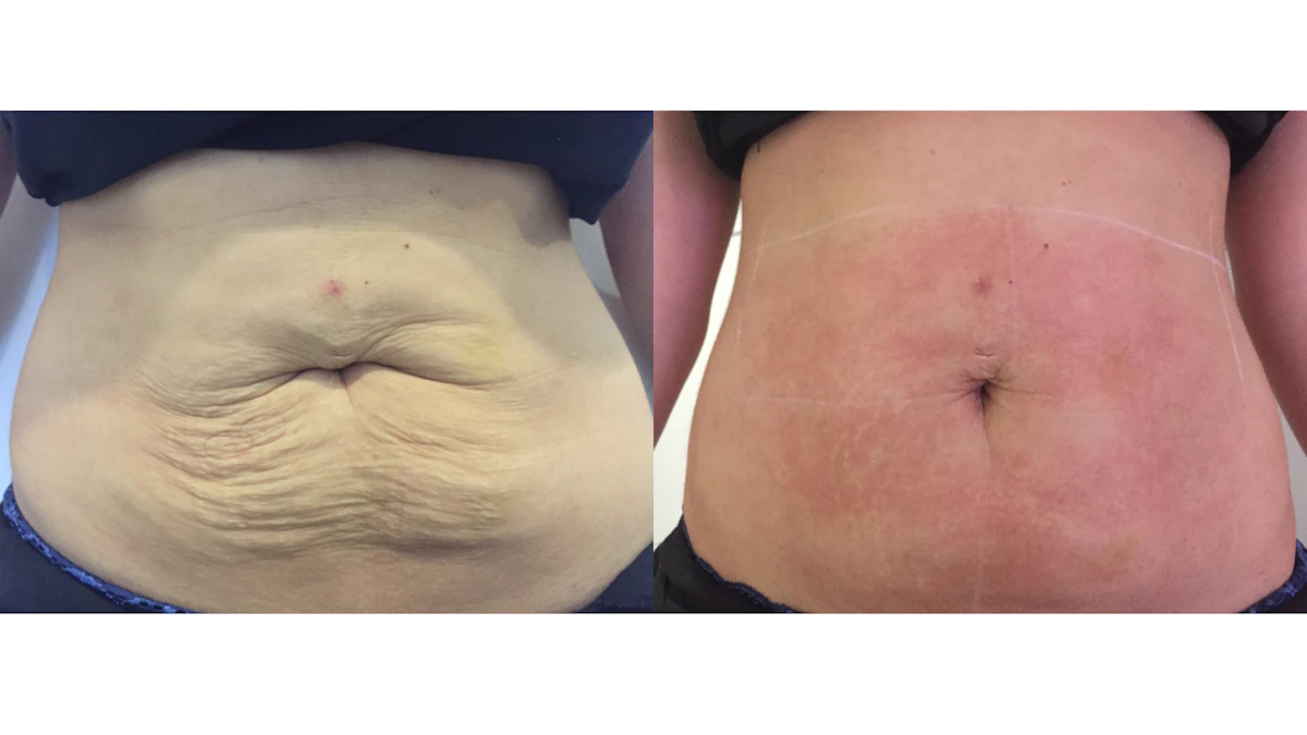 Before and after Ultraformer, EF MEDISPA London