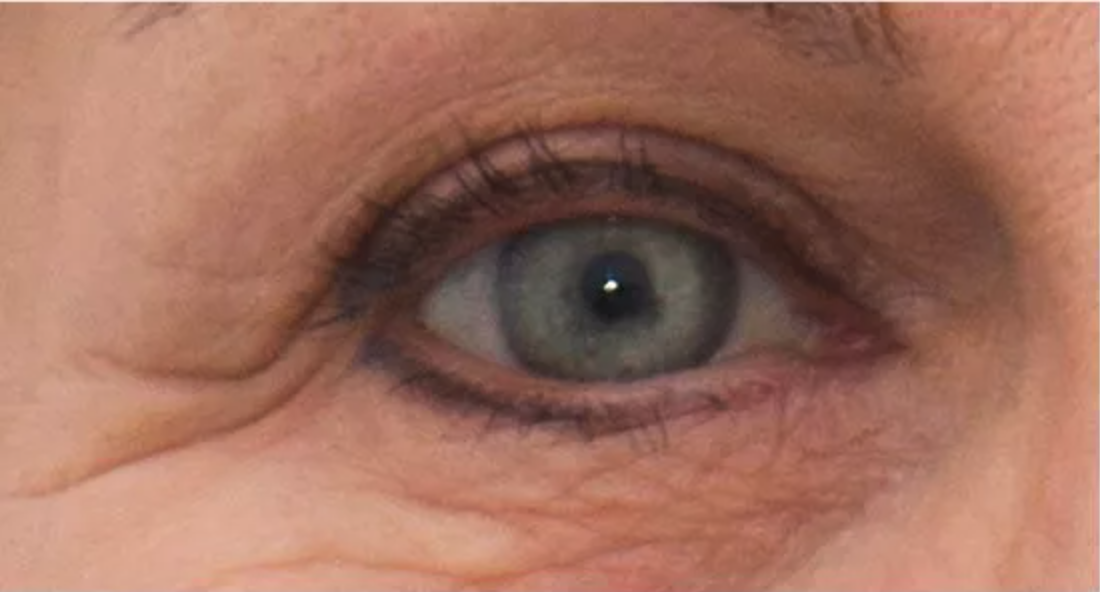 Before anti-wrinkle  injections