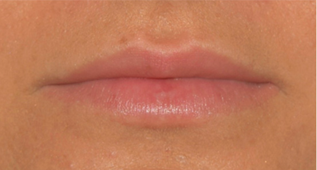 After Dermal Fillers