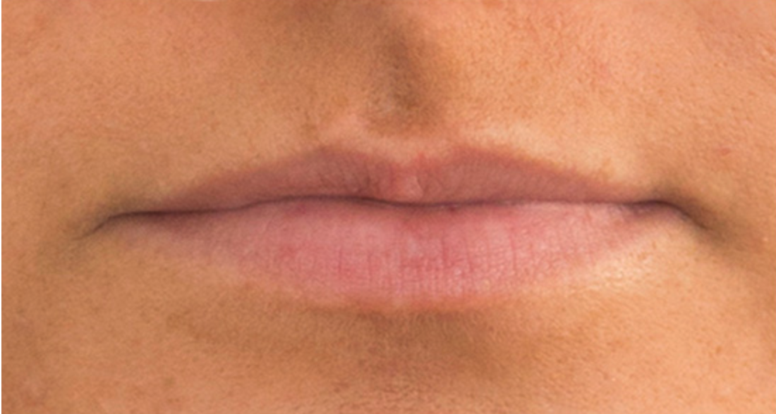 Before Dermal Fillers