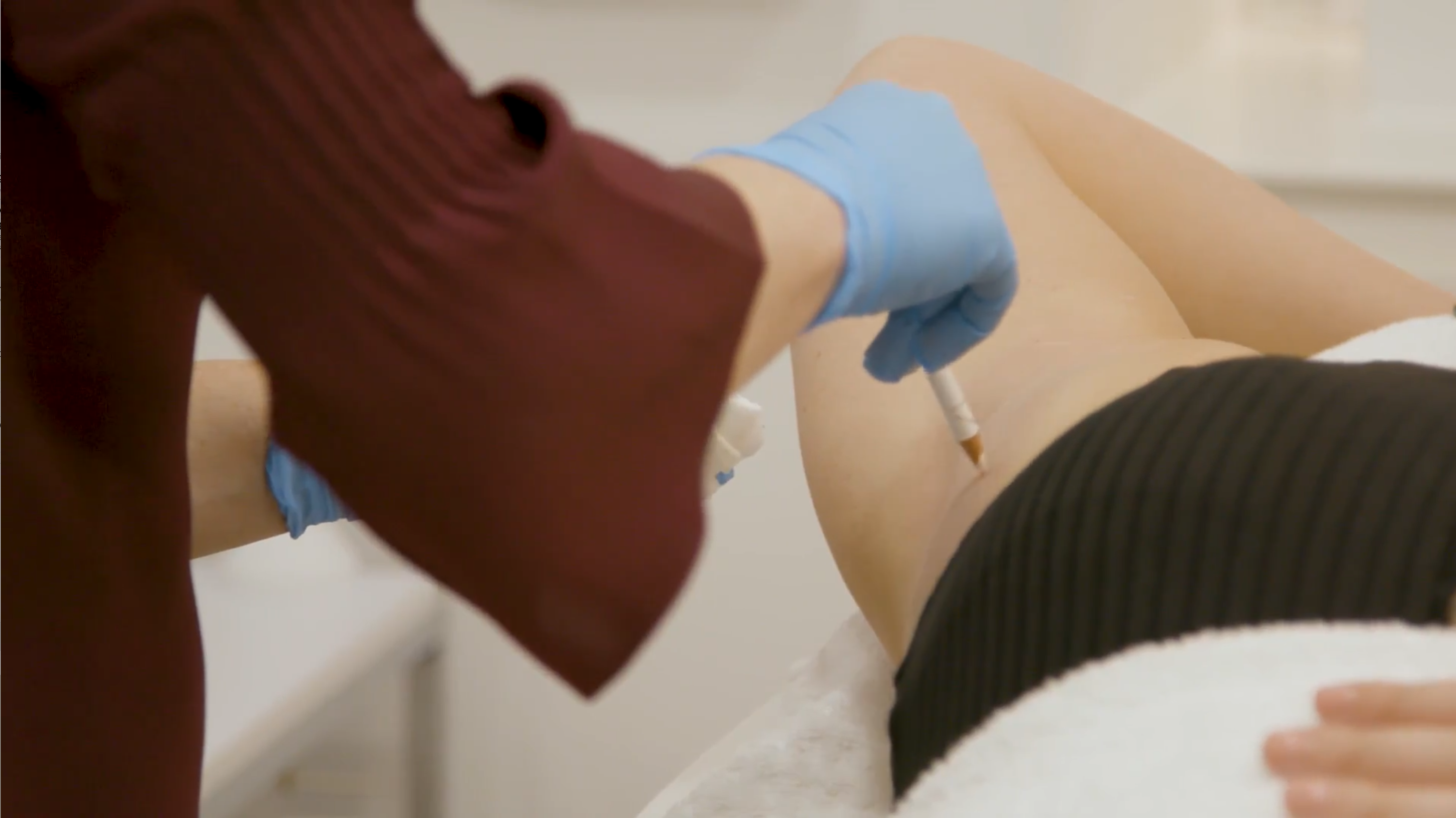 Hyperhidrosis treatment in London