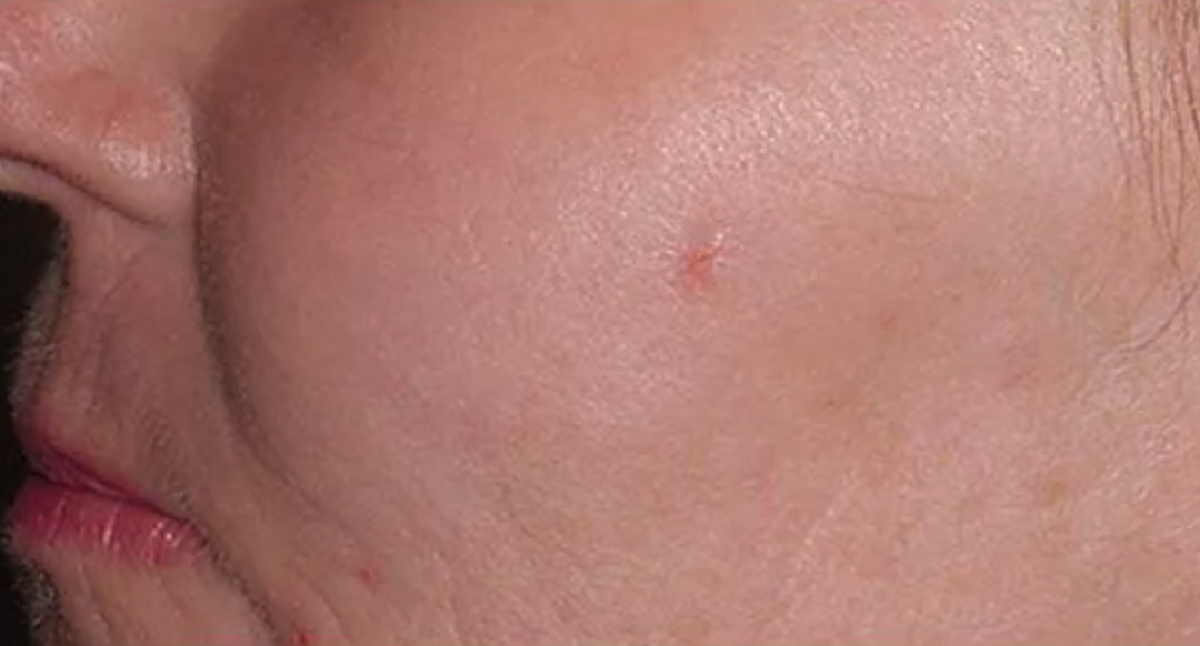 After Fraxel Laser Treatment