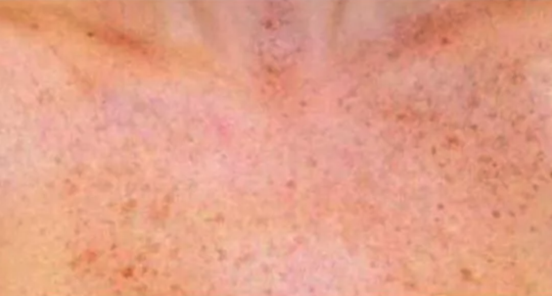 Before Pixel Laser Treatment