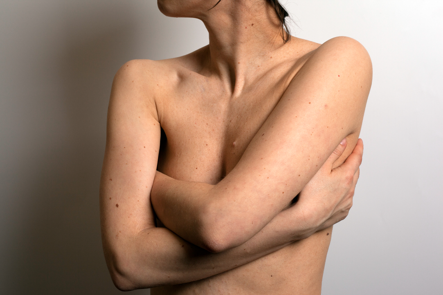 Cosmetic mole removal in London