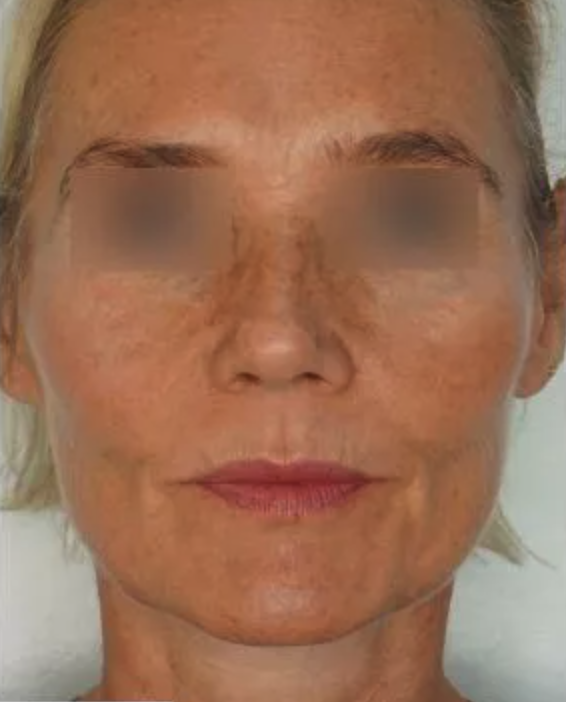 After Profhilo London