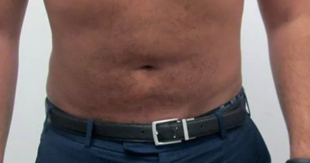After Vaser Liposuction