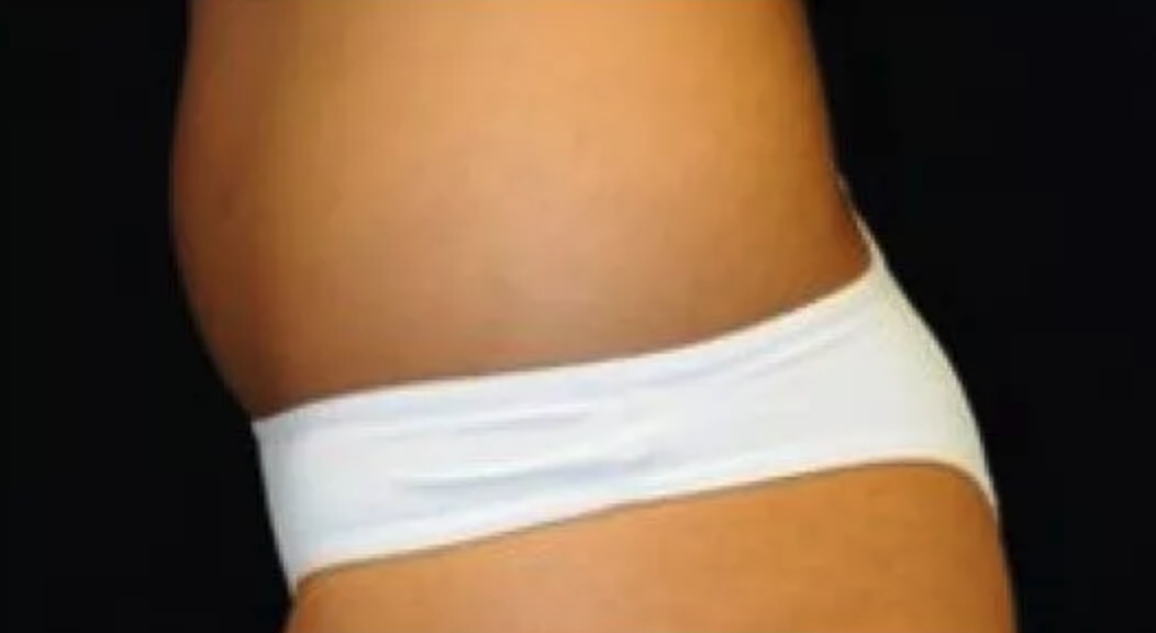 Before Vaser Liposuction