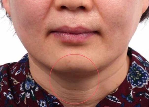 Ultraformer MPT Before and After