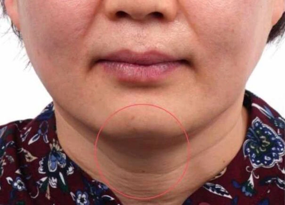 After Ultraformer, face and jawline, EF MEDISPA London