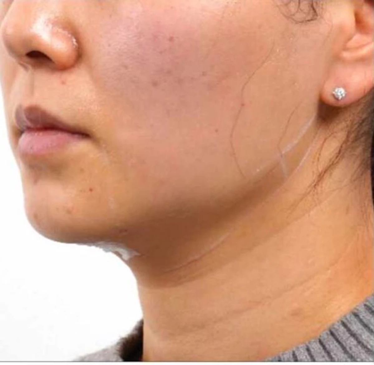 After Ultraformer, chin and neck, EF MEDISPA London