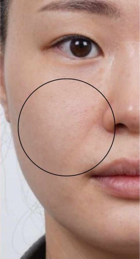 Ultraformer MPT Before and After