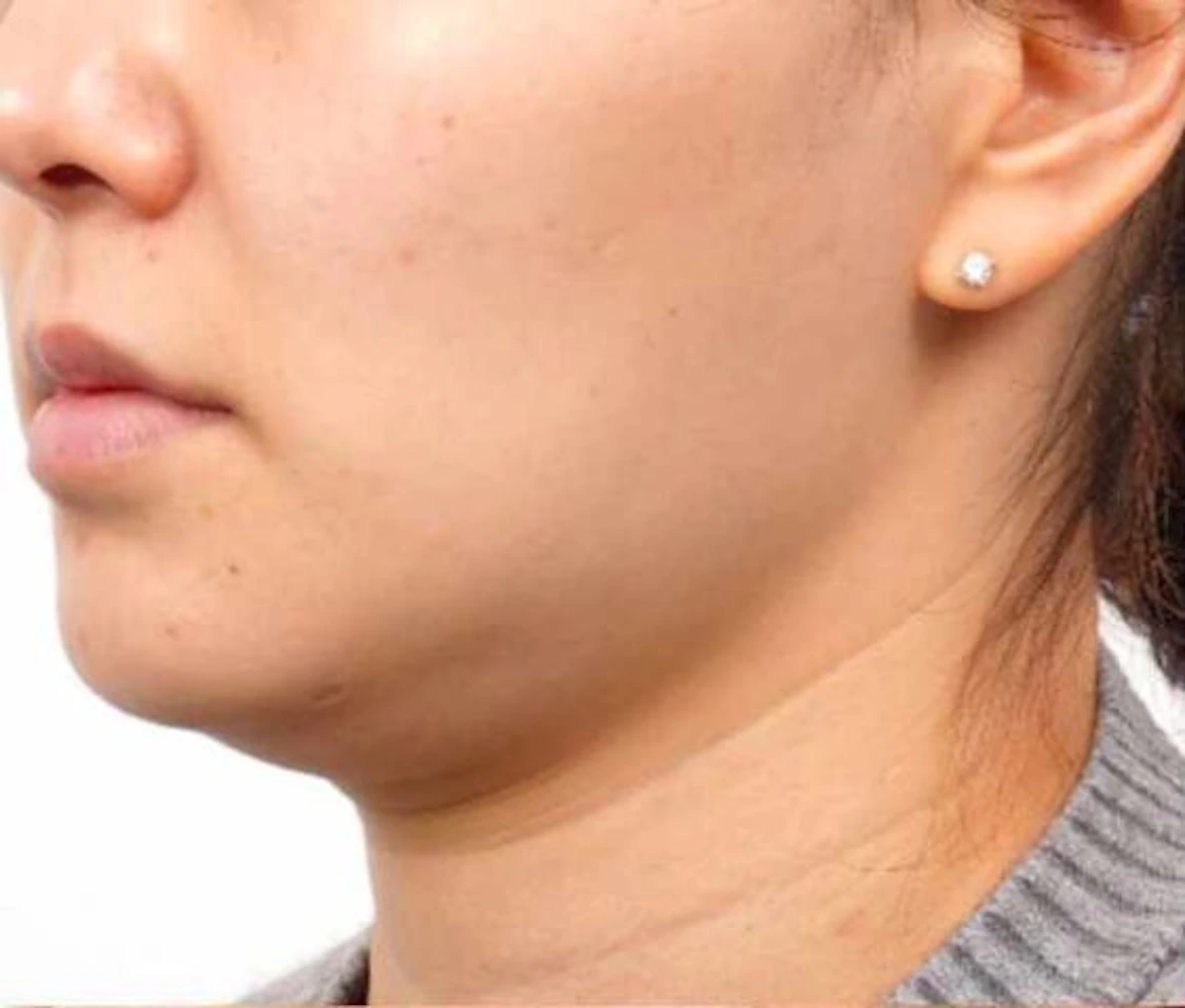 Before Ultraformer, chin and neck, EF MEDISPA London