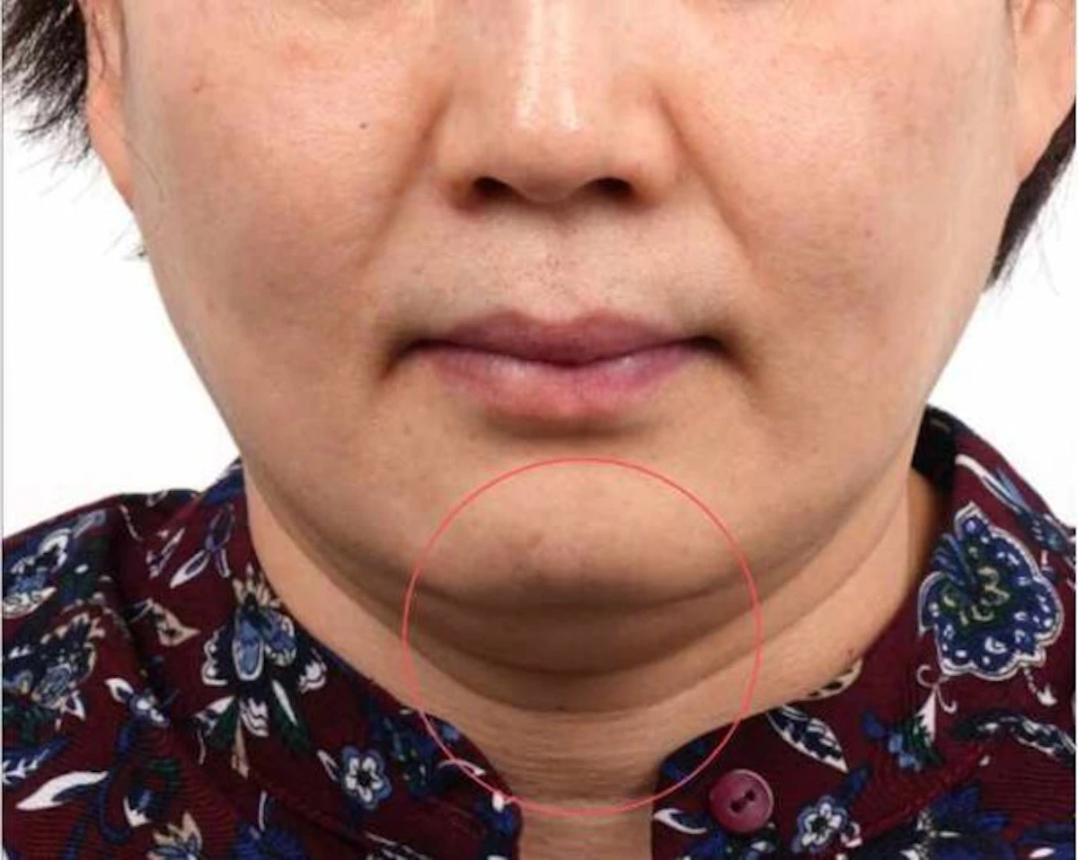 Before Ultraformer, face and jawline, EF MEDISPA London